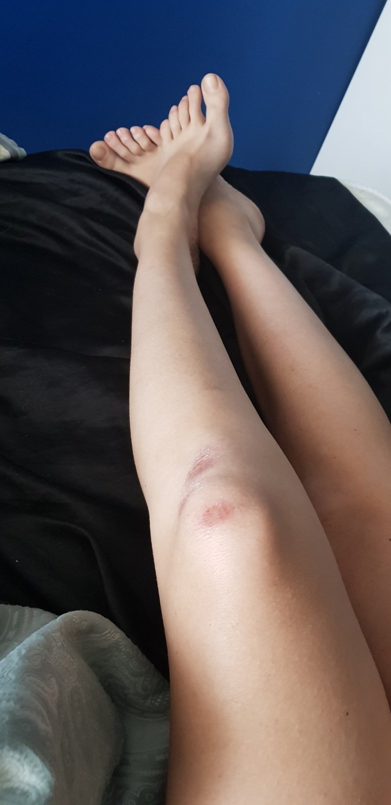 Blood bruise after depilation