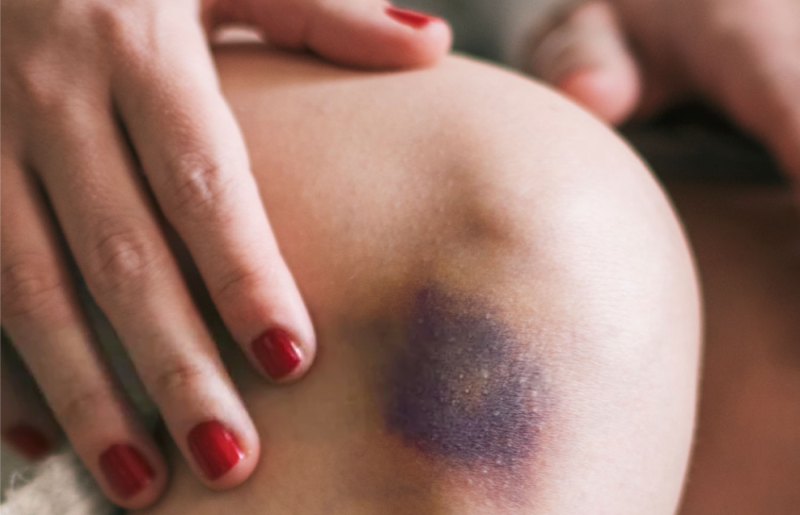 Traces after flogging BDSM