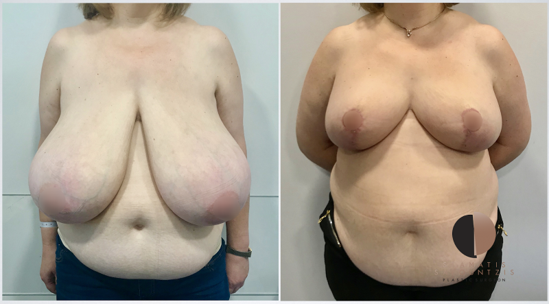 Pregnant bbw with huge tits