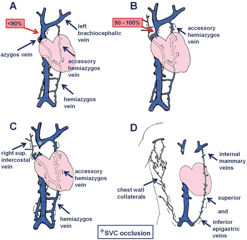 Upper ExtremeMity Vein Anatomy