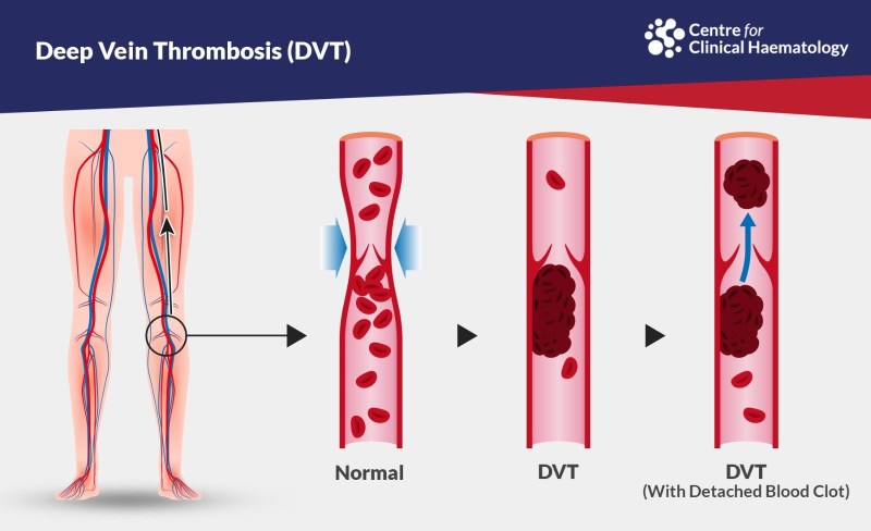 Intercostal vascular bun