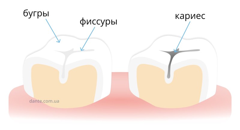 Gel Rox remineralizing before and after