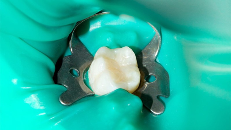 Multi -root pulpitis