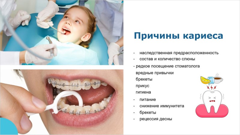 Streptococcus Mutans Caries