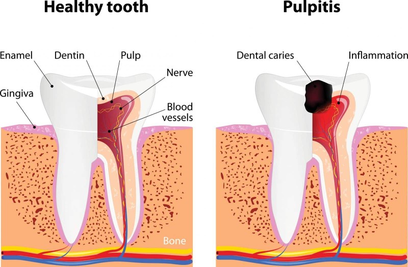 Caries treatment advertising
