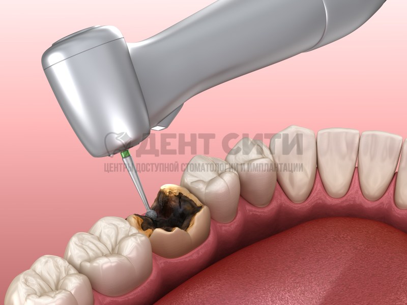Destroyed tooth from caries