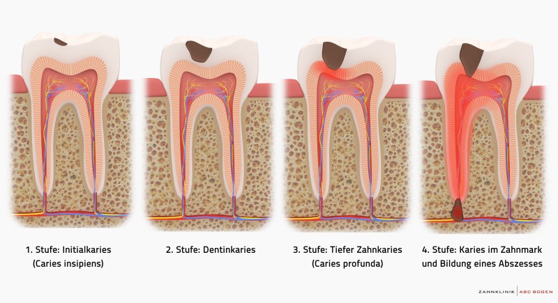 Healthy and sick tooth