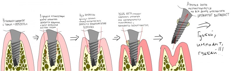 Remineralization of enamel scheme