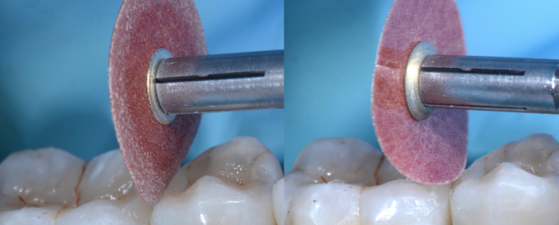 Caries pulpite periodontitis table