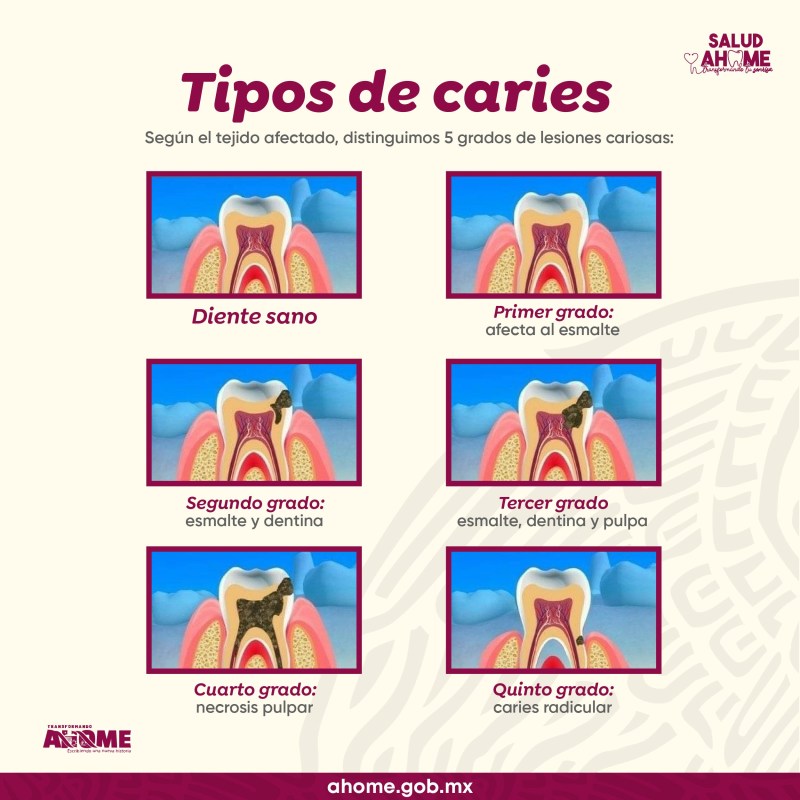 Caries pulpite periodontitis