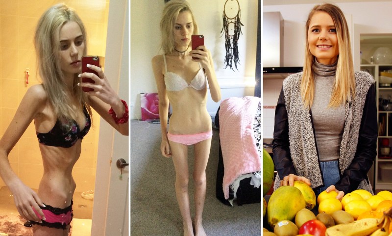 Alice Glinsky anorexica