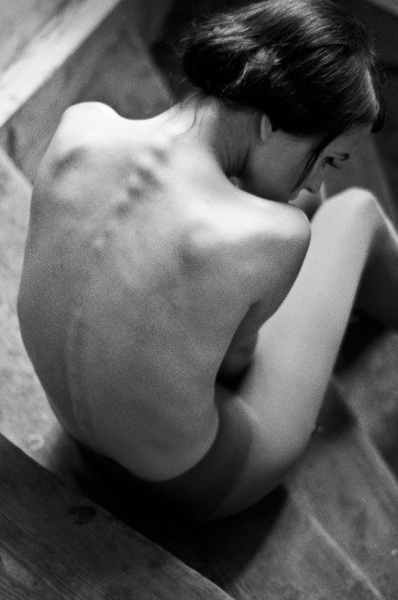 Kaitlin Davidson Anorexia