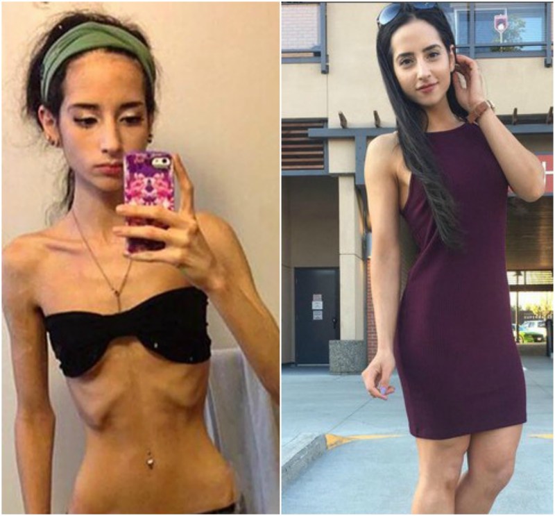 Selfie girls with anorexia