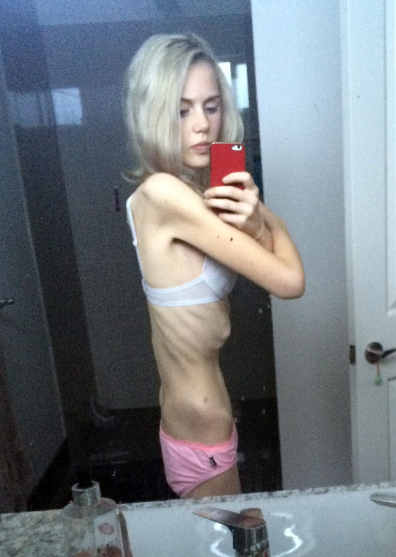 Anorexia in underwear