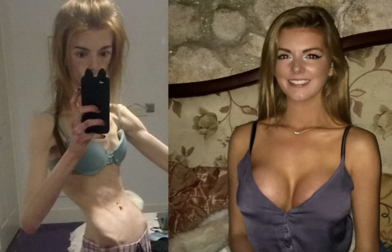 Dismorphomanic anorexia