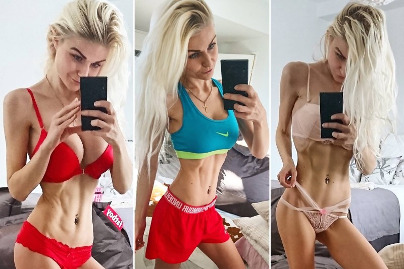 The consequences of anorexia