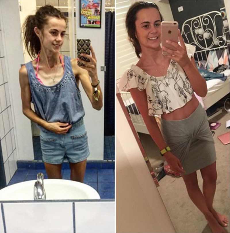 Katie Campbell Anorexia