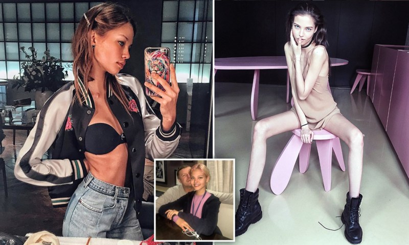 Khilkevich Anna Anorexia Anorexia