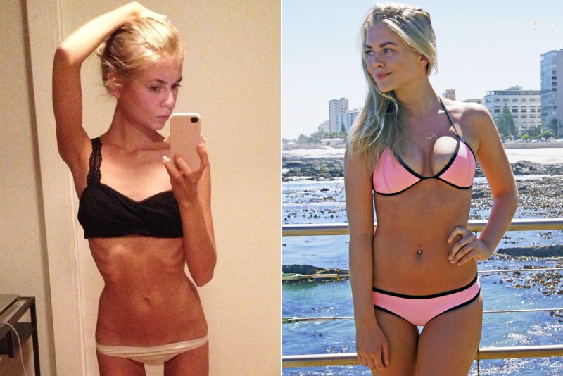 What Do People, Suffering from Anorexia, Do?