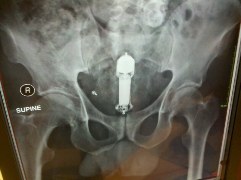 Artificial vagina in vagina