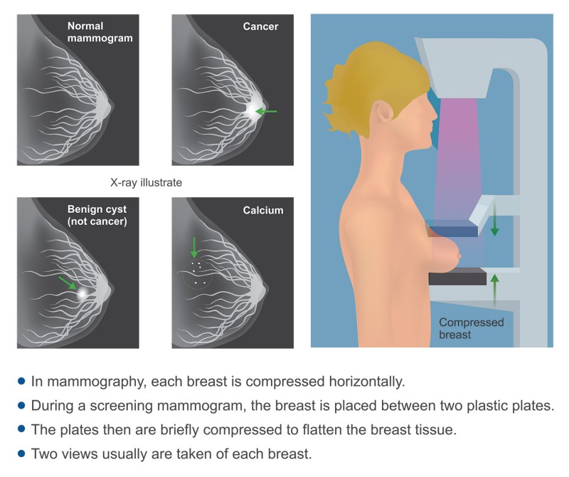 Breastic gland compression