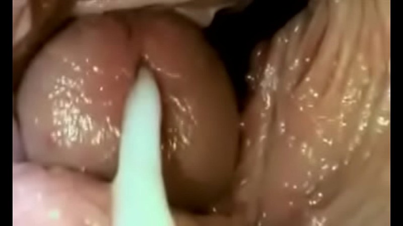 Vaginal beads in vagina