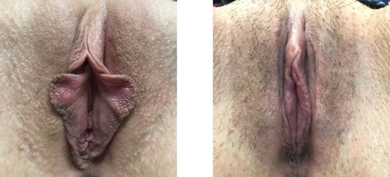 High location of the vagina