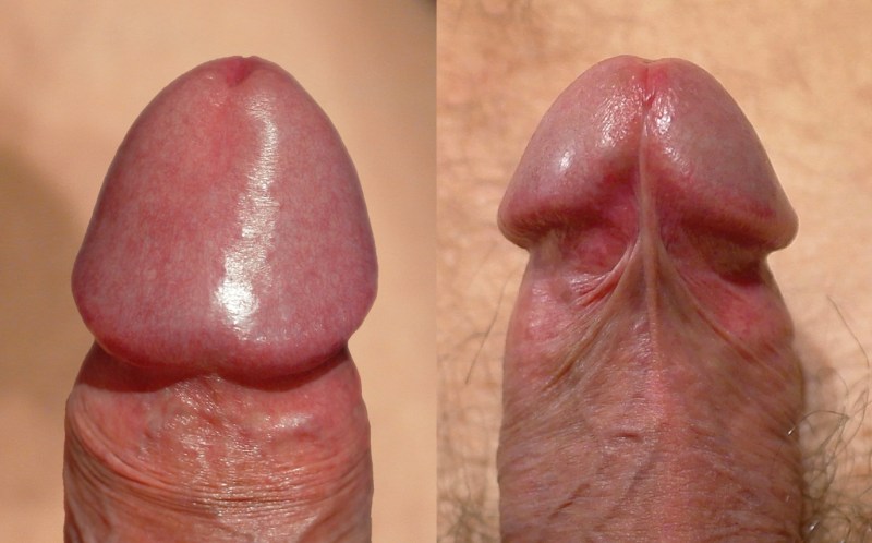 Effects of Early Masturbation on the Penis