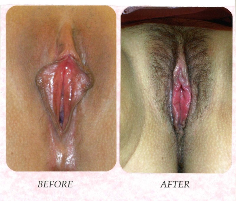 Gynecological examination of the vagina
