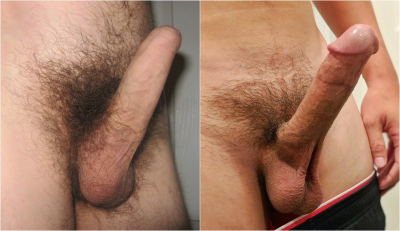 Foreskin Retraction of Uncircuit Penis