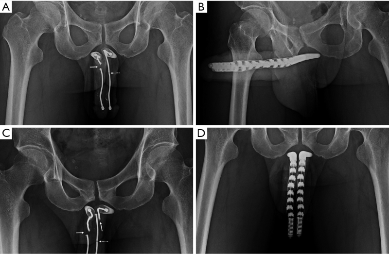 Comparison of the white and black member
