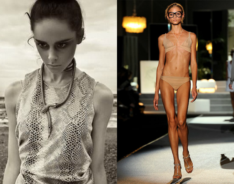 Naked anorexics