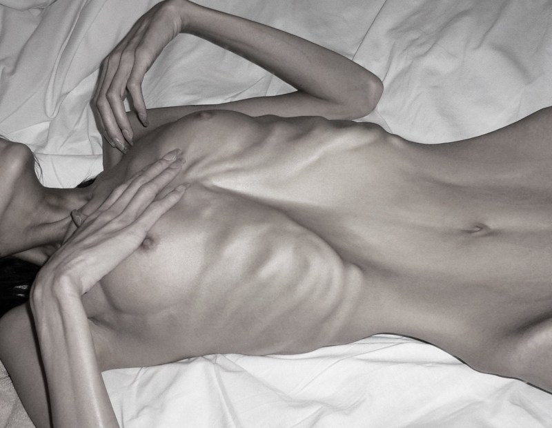 Beautiful naked anorexics