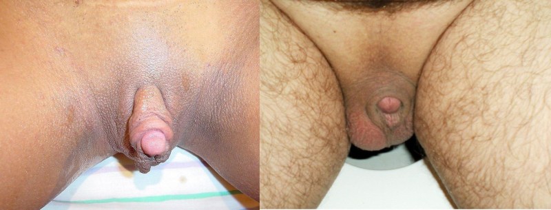 The smallest male penis