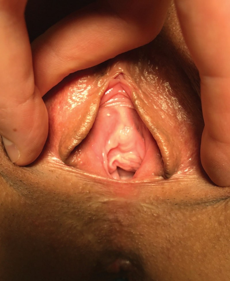 Women's urethra close -up
