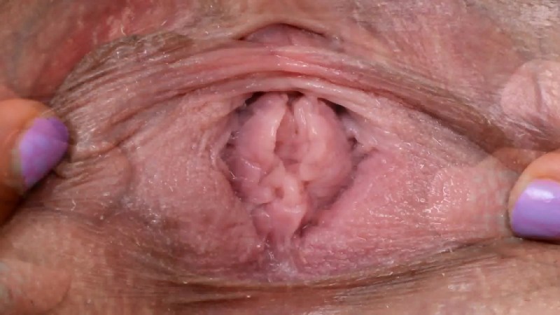 Vaginal papillomatosis