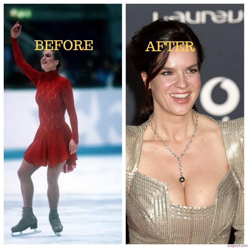 Katarina Witt exposed her chest