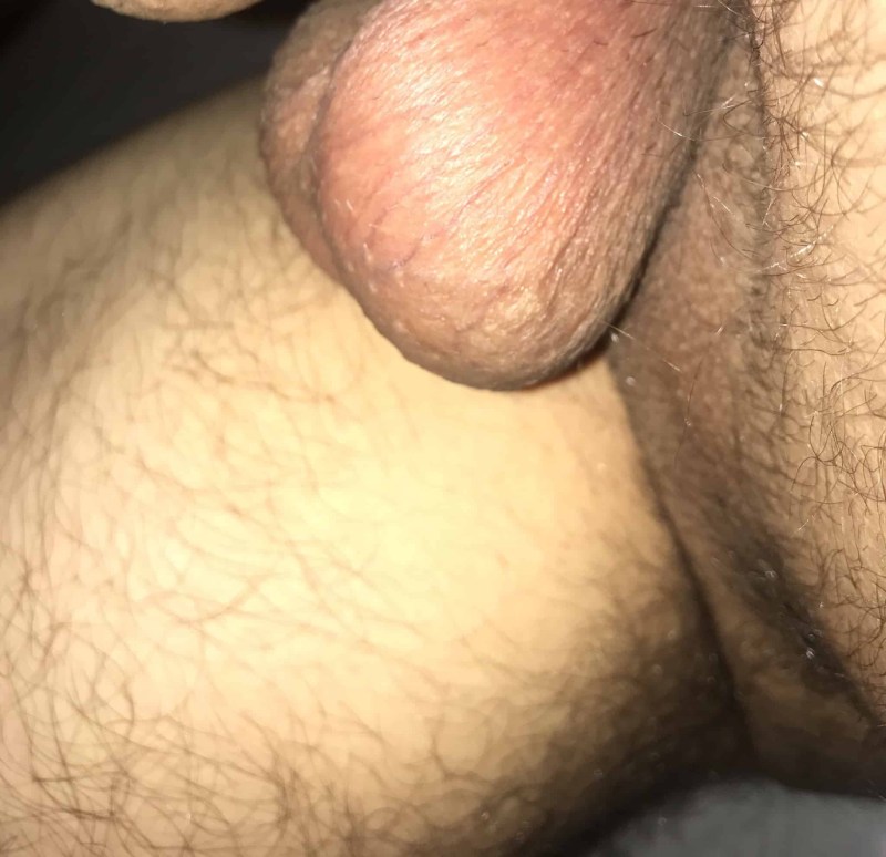 The expansion of the veins of the scrotum