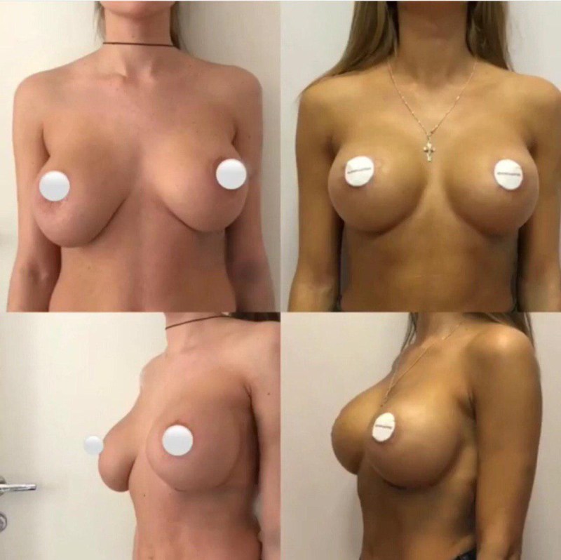 Implants Silicone Mentor 325