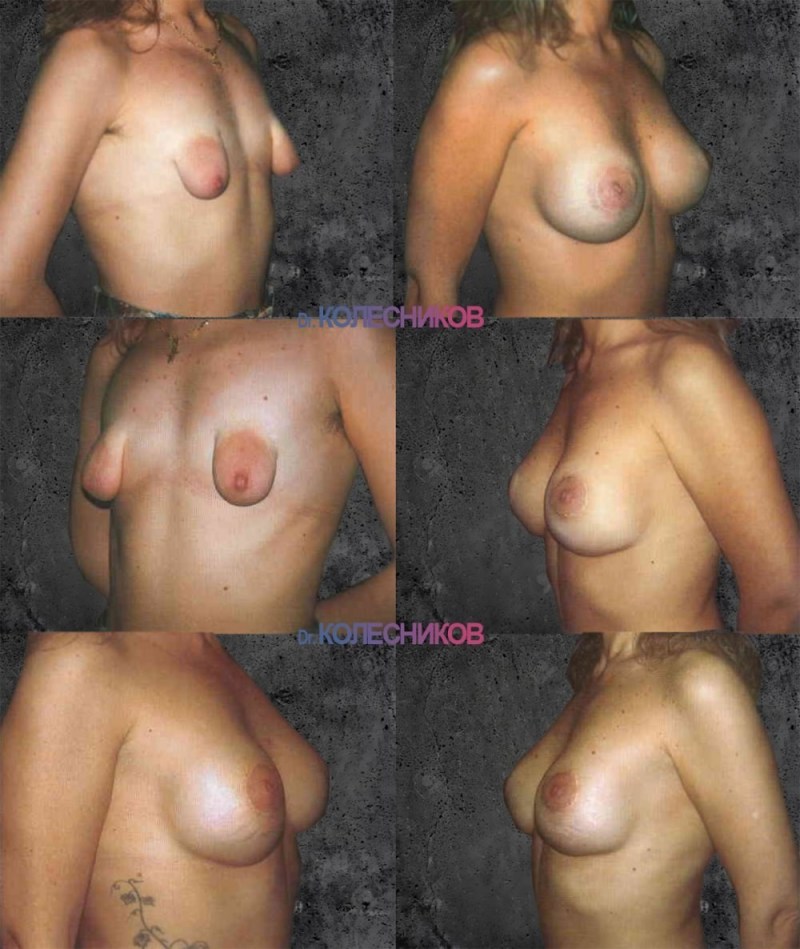 Tubular breasts are naked