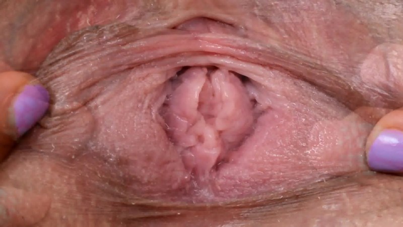 Genital warts in the vagina