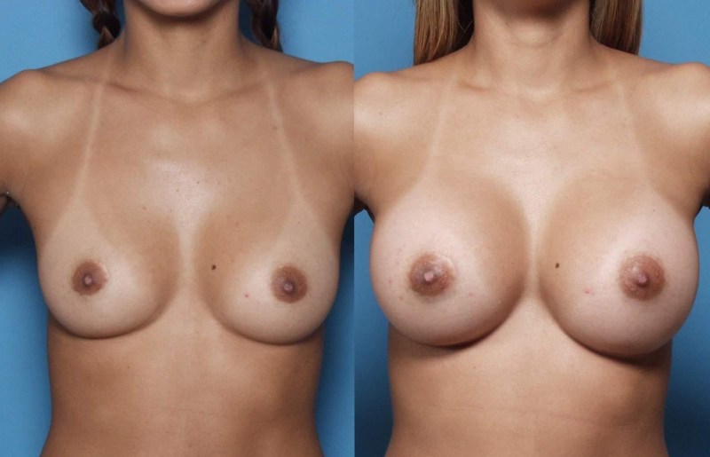 Beautiful female breasts with implants