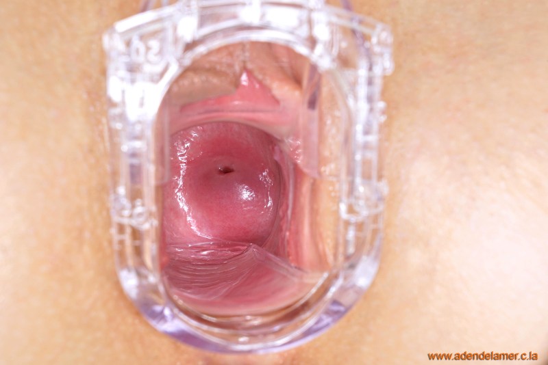 Gynecological mirror in the vagina