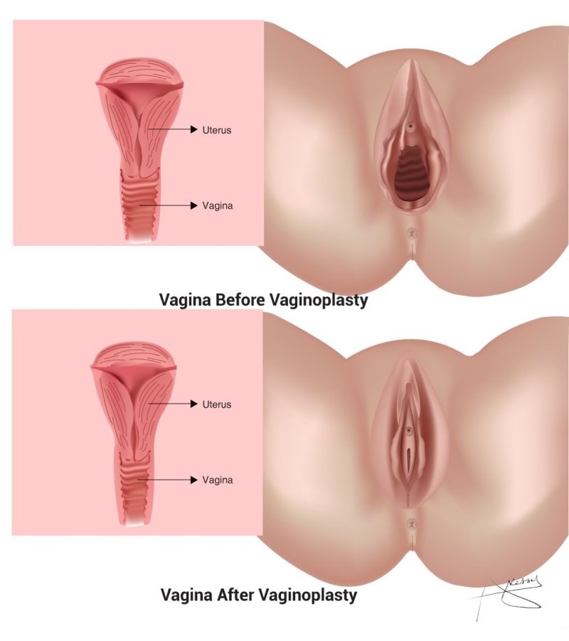 High location of the vagina